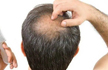 Thane woman lodges case against husband for hiding his baldness
